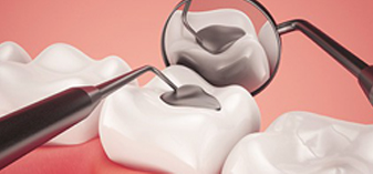 SE Calgary Dental Crowns and Dental Fillings | Walden Family Dental