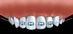 Orthodontics | Walden Family Dental