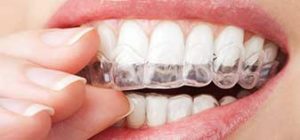 Orthodontics | Walden Family Dental