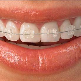 SE Calgary Orthodontic Dentistry | Walden Family Dental