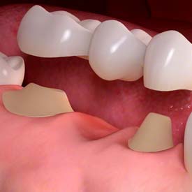 Dental Bridges | Walden Family Dental