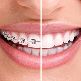 Orthodontic Dentistry | Walden Family Dental
